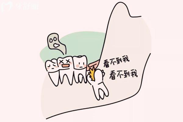 阻生智齒卡通圖
