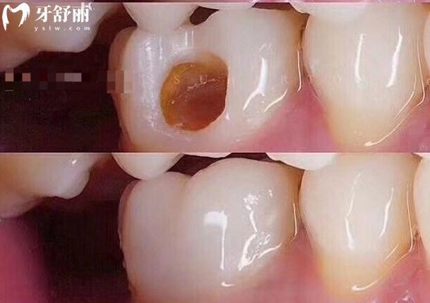 樹脂補牙