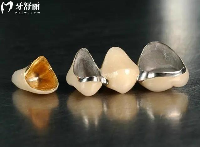 不同材質的牙冠