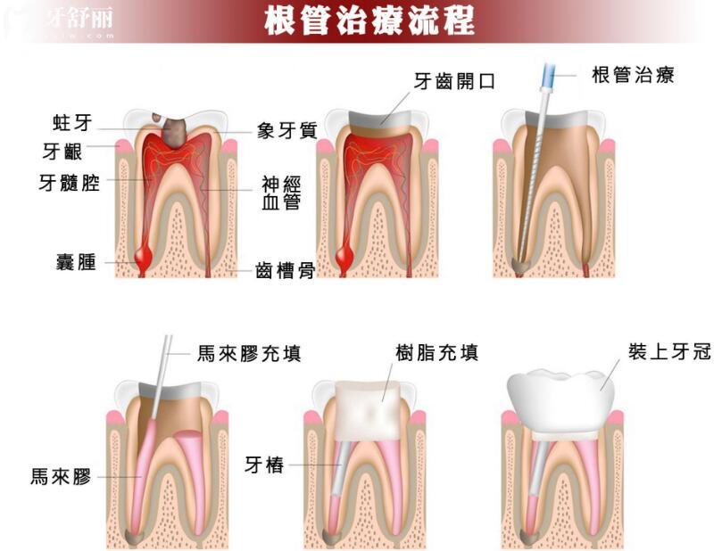 根管治療后不戴牙冠，會(huì)出現(xiàn)什么情況？
