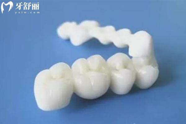 進口全瓷牙冠