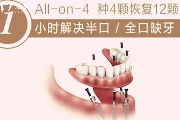安順牙科醫(yī)院種植價格表