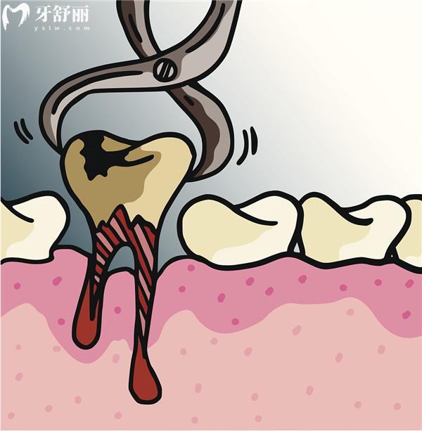 大理拔牙多少錢一顆