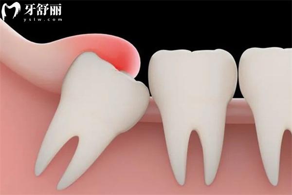 天津塘沽口腔醫(yī)院拔智齒價格表