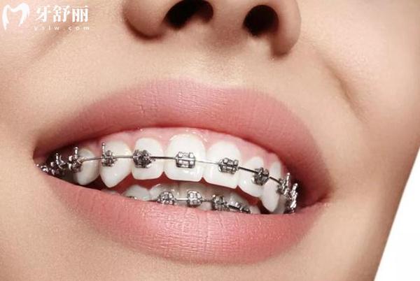 天津塘沽口腔醫(yī)院正畸價格表