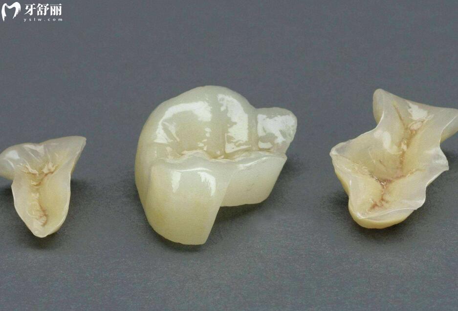 北海諾貝爾口腔嵌體補(bǔ)牙