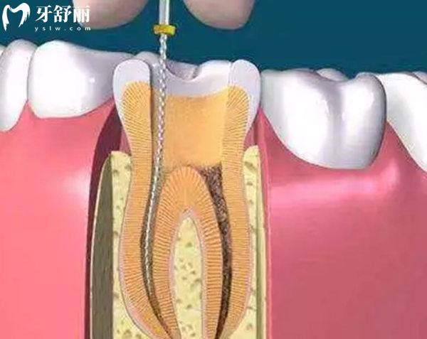天津根管治療費用