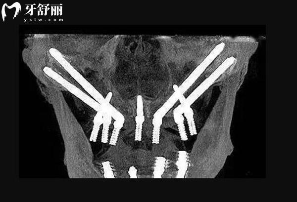 畢節(jié)金沙柯品牙管家口腔種植牙價(jià)格表