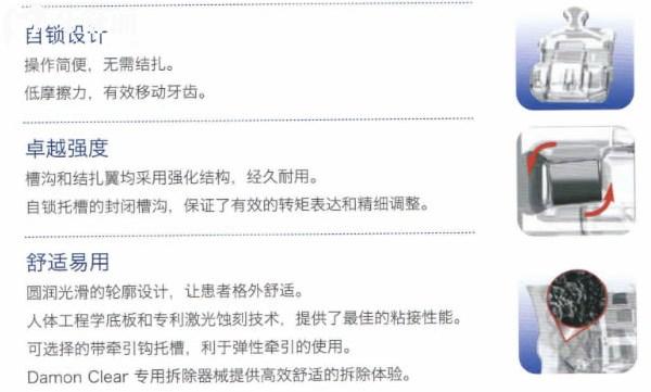 Damon Clear陶瓷自鎖托槽性能優(yōu)勢(shì)