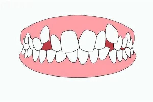 牙齒畸形需要矯正