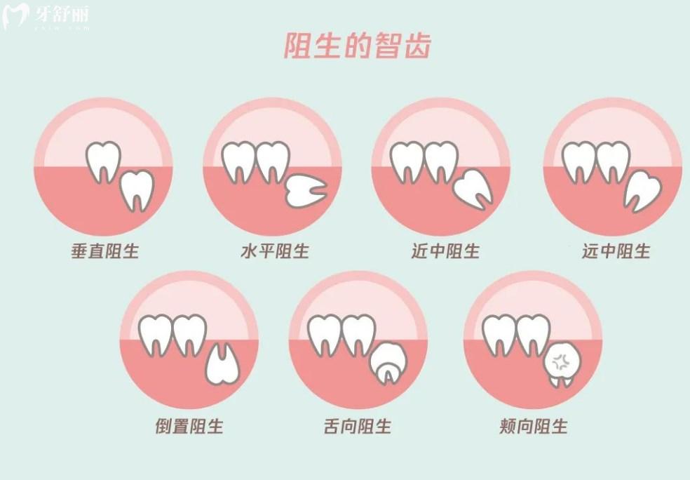 常見(jiàn)智齒種類(lèi)