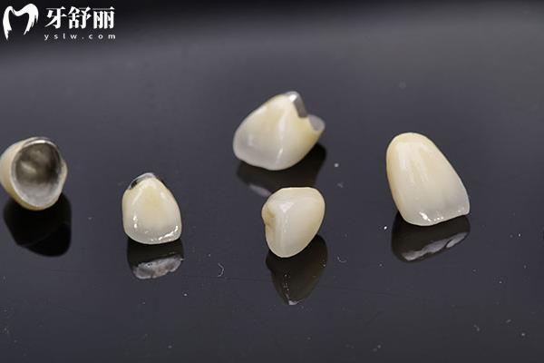 金屬冠