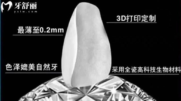 超薄瓷貼面的優(yōu)勢