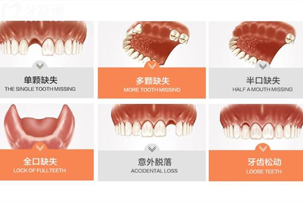 西安種植牙收費價目表