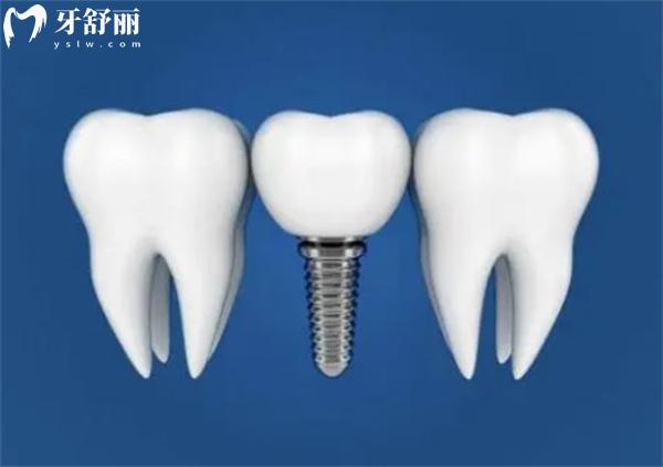 石家莊種植牙收費(fèi)標(biāo)準(zhǔn)
