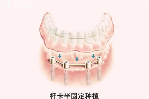 2024石家莊半口種植牙價(jià)格表