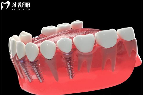 種植牙失敗了費(fèi)用誰(shuí)承擔(dān)?可以要求醫(yī)院賠償退錢(qián)嗎?