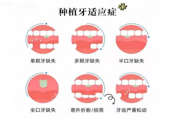 種植牙失敗了費(fèi)用誰(shuí)承擔(dān)?可以要求醫(yī)院賠償退錢(qián)嗎?