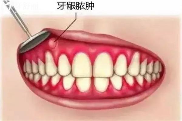牙齦腫起來(lái)一個(gè)肉包圖片大全