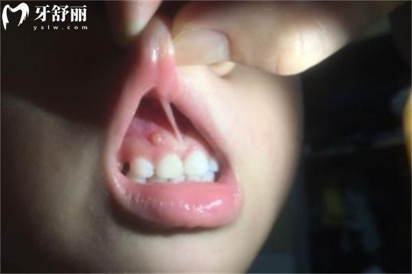 牙齦腫起來(lái)一個(gè)肉包特別疼一按就出血什么原因？