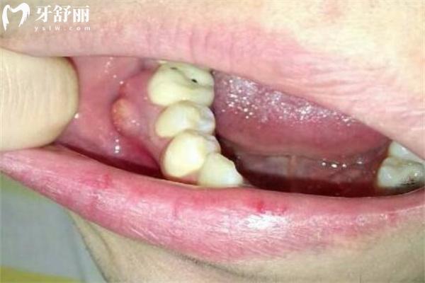 牙齦腫起來(lái)一個(gè)肉包圖片大全