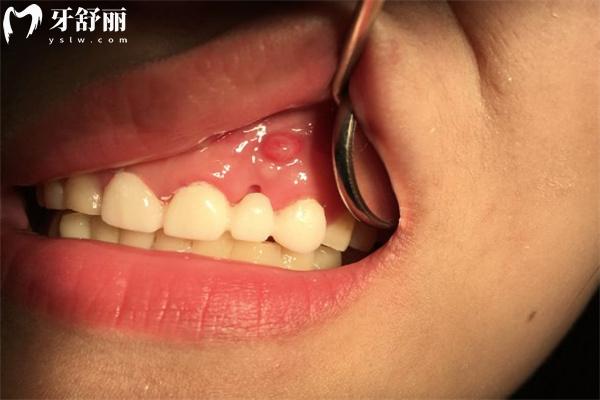 牙齦腫起來(lái)一個(gè)肉包圖片大全