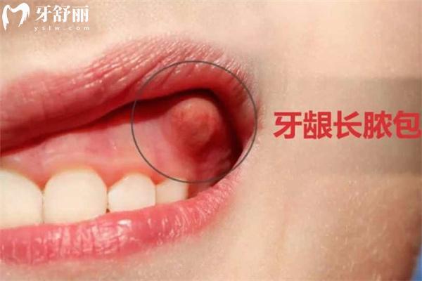 牙齦腫起來(lái)一個(gè)肉包圖片大全