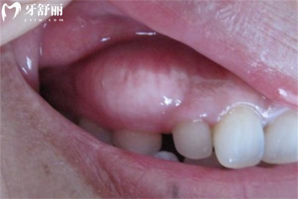 牙齦腫起來(lái)一個(gè)肉包圖片大全