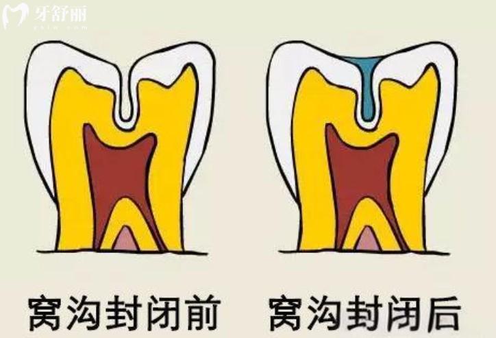 窩溝封閉對比圖