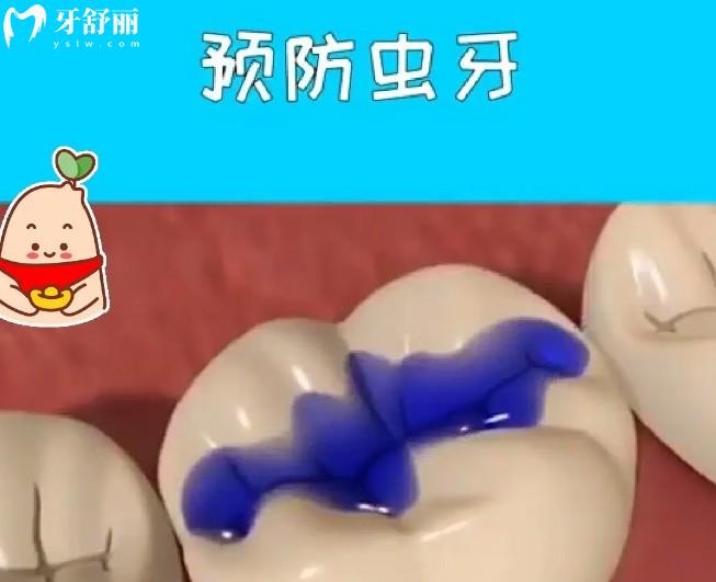 窩溝封閉的好處有哪些