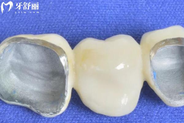 牙齒不整齊做烤瓷牙能變整齊嗎