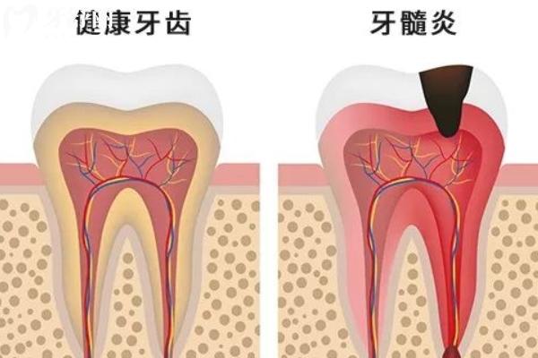 急性牙髓炎和慢性牙髓炎有什么區(qū)別？