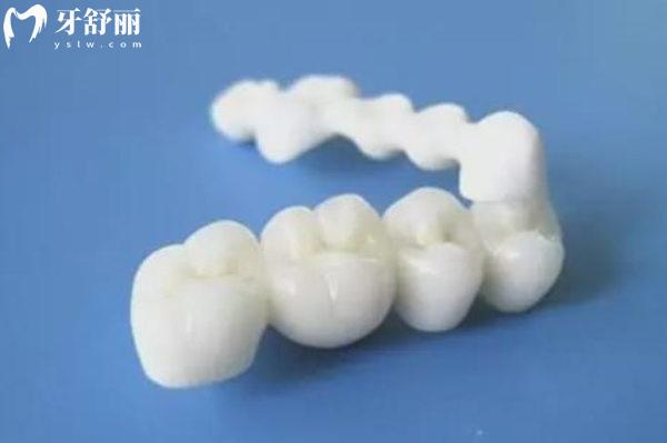 鑲牙大概多少錢一顆