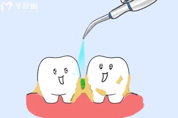 30歲做了滿(mǎn)口烤瓷牙能用一輩子嗎