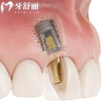 哈爾濱醫(yī)大**種植牙多少錢?一顆2880+半口1.6萬全口費用明細公開