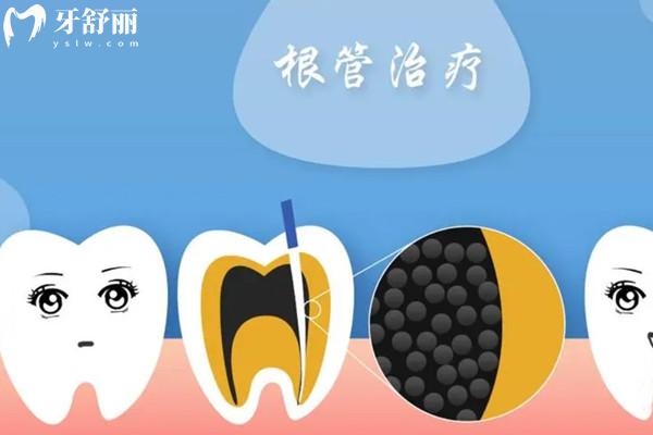 沒了牙神經(jīng)的牙可以保持多久