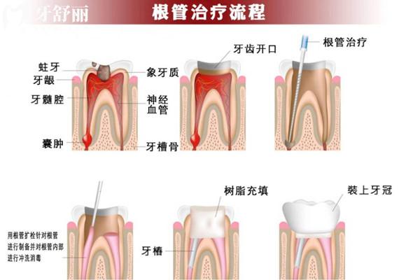 沒了牙神經(jīng)的牙可以保持多久
