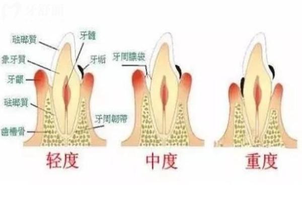 牙齦萎縮不同程度對比