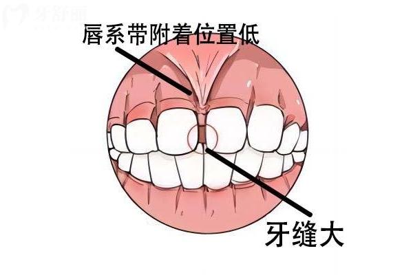 孩子牙縫大是什么原因