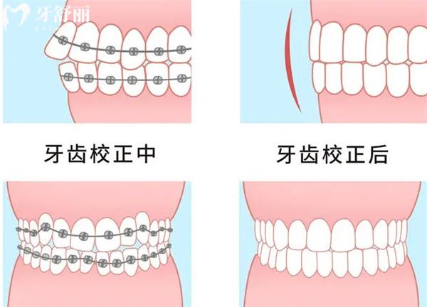 天津濱海新區(qū)牙科牙齒矯正多少錢