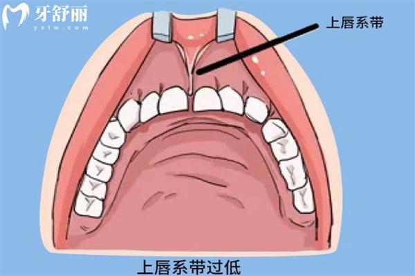 笑露牙齦與唇系帶有關(guān)系嗎？