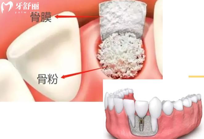 牙槽骨植骨手術(shù)成功概率多少
