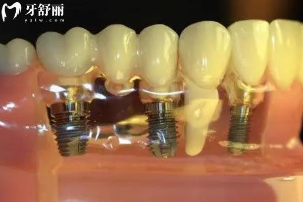 種植牙種什么材質(zhì)的好？