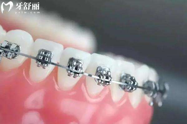 蘭州牙齒矯正大概要花費(fèi)多少錢