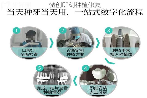 即刻種植全程