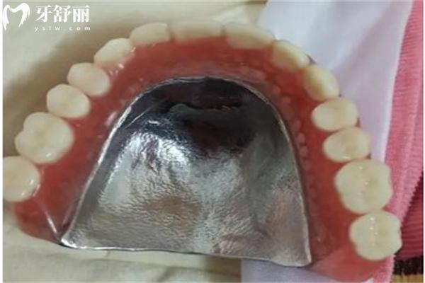 吉林全口假牙價(jià)格表