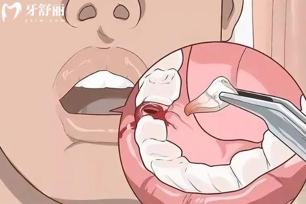 為什么牙疼的時候不能拔牙？