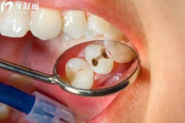 齲齒的類型有哪些？齲齒該如何治療？