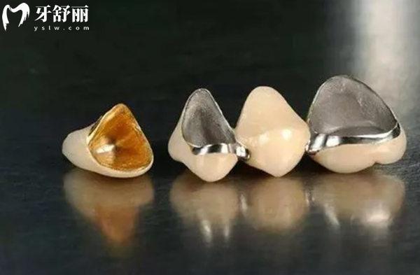 西寧鑲烤瓷牙價格多少錢一顆？
