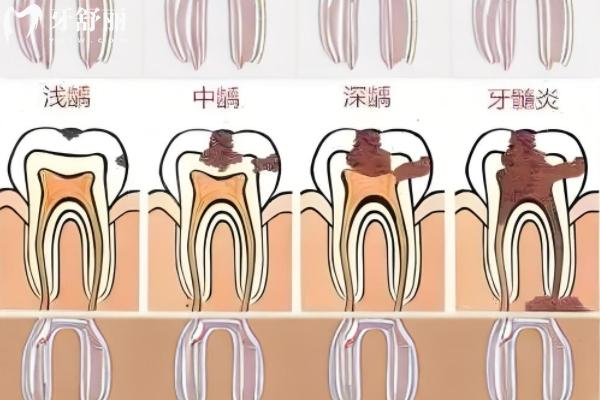 先洗牙還是先拔牙補(bǔ)牙？